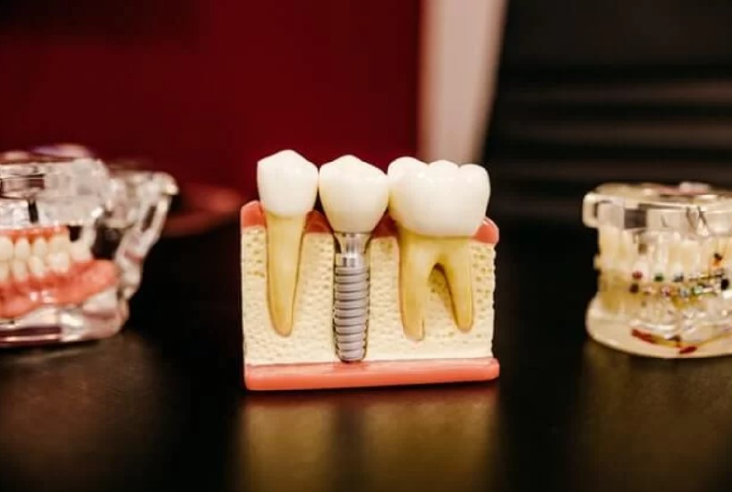 Află informații de care ai nevoie dacă dorești să apelezi la un implant dentar!