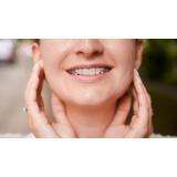 Aparatul dentar: secretul unui z&acirc;mbet perfect la orice v&acirc;rstă