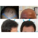 Ce-o fi &icirc;n capul lor? De ce există așa mare interes de a afla informații despre implantul de păr? 