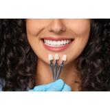 Ce sunt fațetele dentare și cum pot &icirc;mbunătăți aspectul z&acirc;mbetului tău?