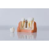 Implanturi dentare vs punți dentare - care este cea mai bună opțiune pentru tine?