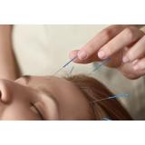 Acupunctura este un remediu benefic pentru diminuarea durerilor de cap