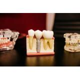 Află informații de care ai nevoie dacă dorești să apelezi la un implant dentar!