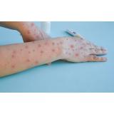 Un al cincilea caz de infectare cu variola maimuței depistat &icirc;n Rom&acirc;nia