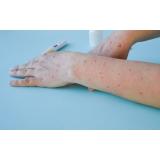 Alte două cazuri de variola maimuței au fost confirmate &icirc;n Rom&acirc;nia. OMS se g&acirc;ndește la o urgență de sănătate publică