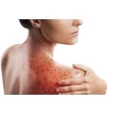 Un alt caz de variola maimuței &icirc;n Rom&acirc;nia. Bilanțul total