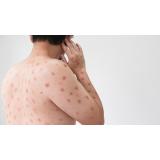 Rom&acirc;nia mai &icirc;nregistrează un caz de variola maimuței. Bilanțul total al cazurilor