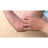 Alte două cazuri de infectare cu variola maimuței confirmate &icirc;n Rom&acirc;nia. Bilanțul total al cazurilor raportate