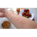 Ce este urticaria și de ce apare?