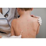 Un copil de 7 ani cu o formă de varicelă foarte rară, internat la Spitalul de Boli Infecțioase din Timișoara