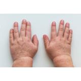 Epidemie cu o bacterie periculoasă &icirc;n Marea Britanie. Șase copii au decedat