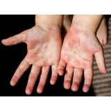 Epidemie de scarlatină &icirc;n grădinițele și școlile din Vaslui