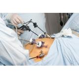 Gastric sleeve: Ce presupune operația de micșorare a stomacului