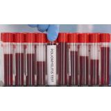 &Icirc;n New York s-a raportat primul caz de poliomielită din SUA din ultimul deceniu