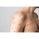 Primul caz de variola maimuței &icirc;n Rom&acirc;nia. Ce spune Ministerul Sănătății despre starea pacientului