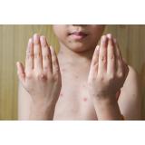 Slovenia a &icirc;nregistrat primul său caz de variola maimuței