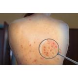 780 de cazuri de variola maimuţei au fost depistate &icirc;n 27 de țări