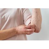 Varicela: cum se transmite și ce complicații pot apărea