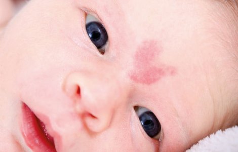 O fetita s-a nascut cu un semn in forma de inima pe frunte