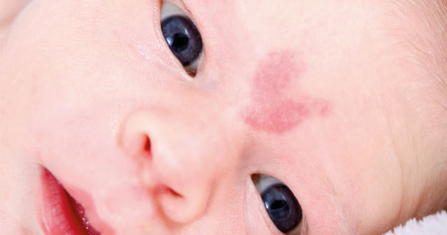 O fetita s-a nascut cu un semn in forma de inima pe frunte