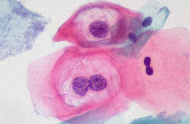 Cancerul provocat de sexul oral, subiect de documentar