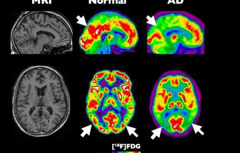 Ultrasunetele, folosite in tratarea Alzheimerului