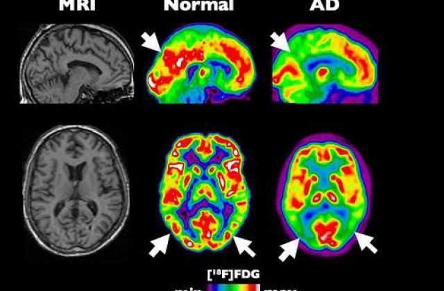 Ultrasunetele, folosite in tratarea Alzheimerului