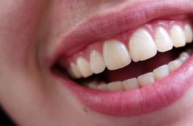 8 trucuri utile si ieftine pentru a avea o dantura de Hollywood