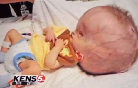  Video  Bebelus nascut cu un cap gigantic