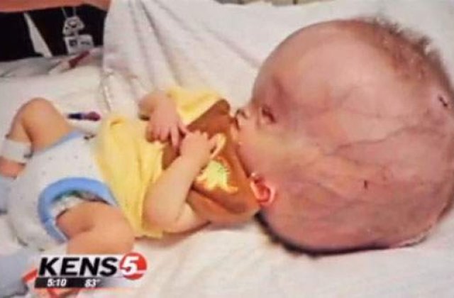[VIDEO] Bebelus nascut cu un cap gigantic