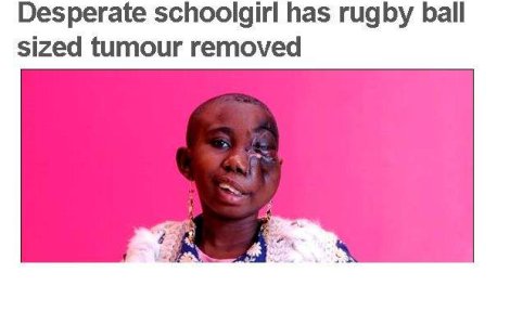  Foto  Tumoare cat mingea de rugby, operata cu succes