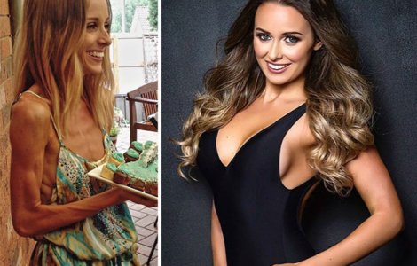  Top  Inainte si dupa anorexie: 10 fotografii cu cei care au invins boala