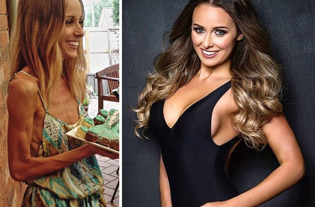 Inainte si dupa anorexie: 10 fotografii cu cei care au invins cumplita boala