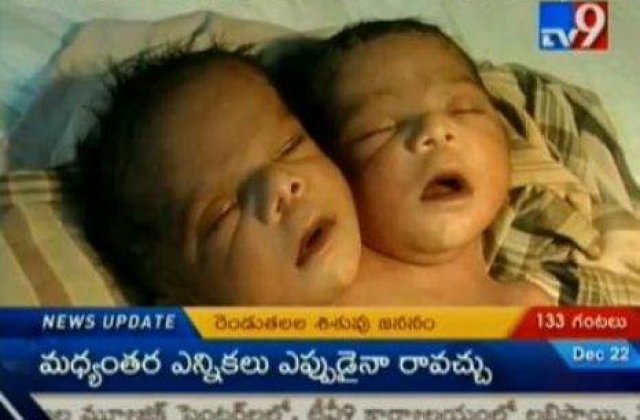 [VIDEO] Un bebelus din India s-a nascut cu doua capete
