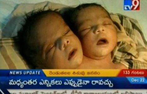  Video  Un bebelus din India s-a nascut cu doua capete