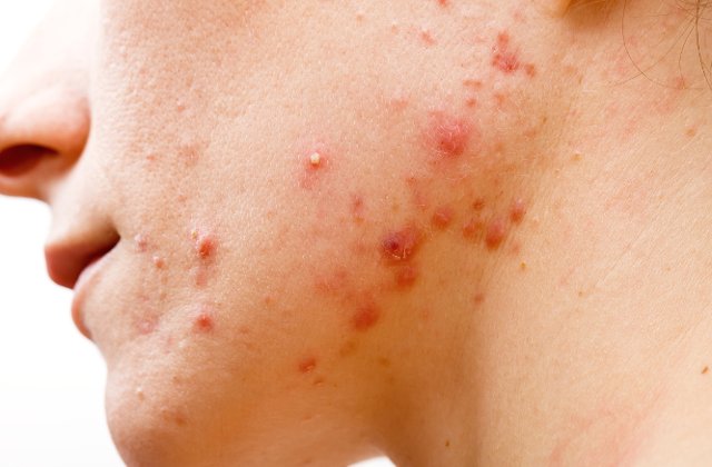 5 indicii ca mananci prea mult zahar