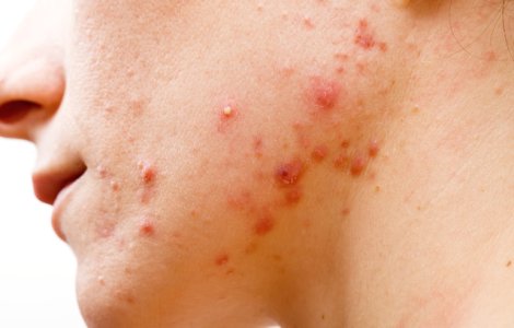  Top  5 indicii ca mananci prea mult zahar