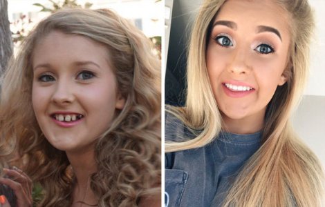  Top  15 persoane transformate complet dupa ce si-au pus aparat dentar