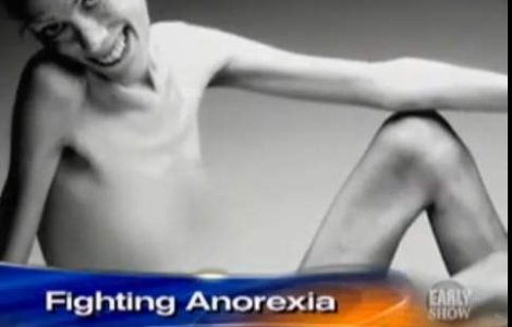  Foto / video  Isabelle Caro, anorexica timp de 15 ani, a murit