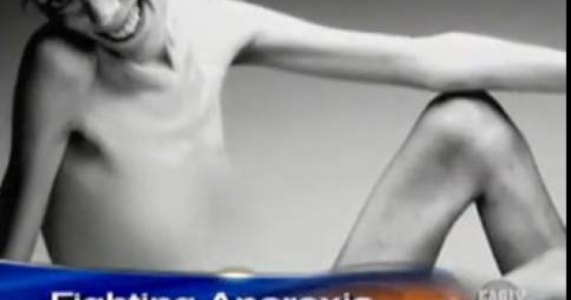  Foto / video  Isabelle Caro, anorexica timp de 15 ani, a murit