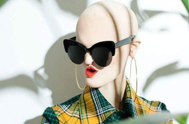 [FOTO] Sufera de o boala genetica rara, dar asta nu a impiedicat-o sa devina model