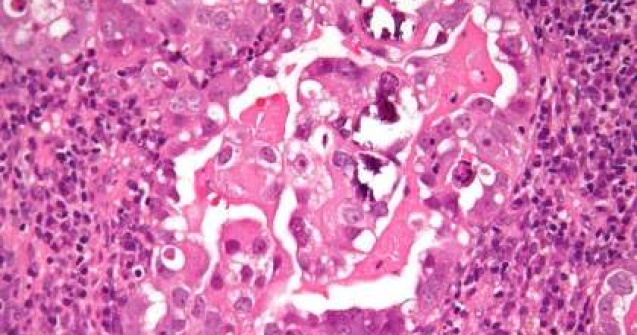 6 romance mor zilnic din cauza cancerului de col uterin