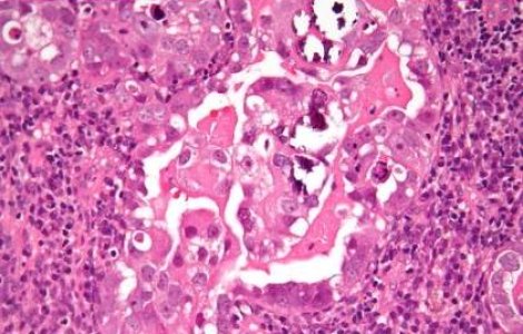 6 romance mor zilnic din cauza cancerului de col uterin