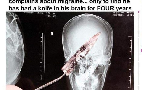 A trait cu un cutit in creier timp de 4 ani
