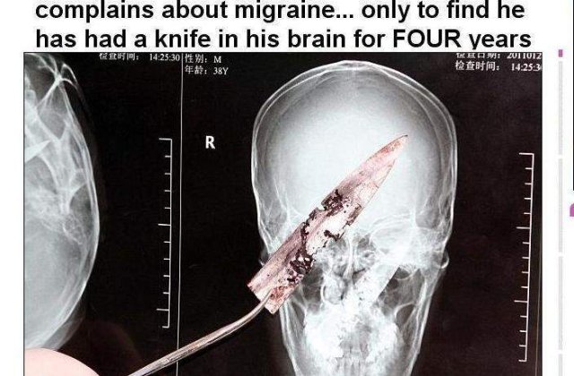 A trait cu un cutit in creier timp de 4 ani