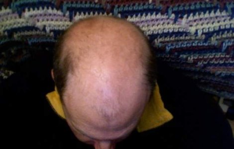 "Adevarul chel": Drogul care-ti face parul sa creasca!