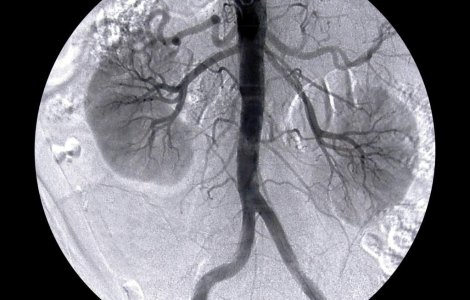 Primul transplant de rinichi intre gemeni din Romania