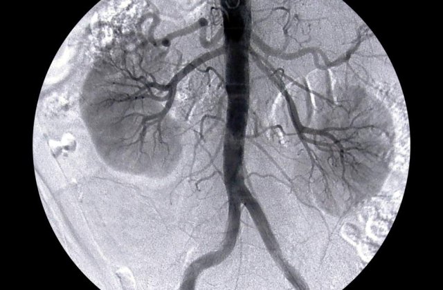 Primul transplant de rinichi intre gemeni din Romania