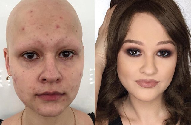 Niciun defect nu e lasat la vedere: 10+1 cazuri in care machiajul a acoperit si cele mai urate cicatrice