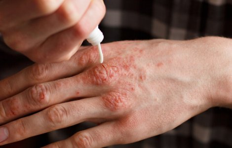 Un nou medicament pentru tratarea psoriazisului va fi scos pe piata